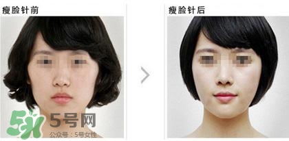 打瘦臉針能喝酒嗎？打瘦臉針能吃海鮮嗎？