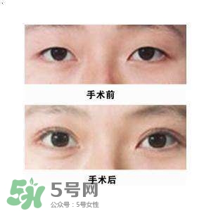 割雙眼皮疼不疼？割雙眼皮疼幾天能好？