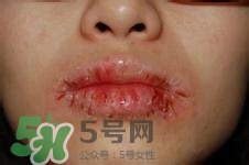 嘴唇干燥是什么原因？嘴唇干裂脫皮怎么辦？