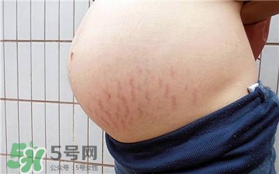 妊娠紋幾個月開始出現？妊娠紋能消除掉嗎？