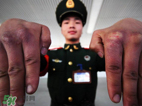 三月份還長(zhǎng)凍瘡嗎？三月份凍瘡沒好怎么辦？