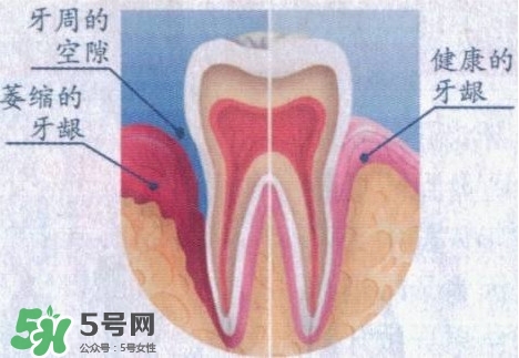 牙齦萎縮怎么辦？牙齦萎縮癥狀