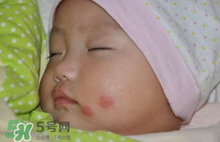 嬰兒被蚊子咬了如何去紅點？被蚊子咬后紅點如何去除？