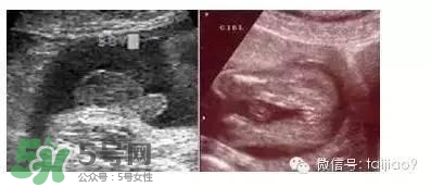 B超單數據怎么看男女？B超單看男女準嗎？