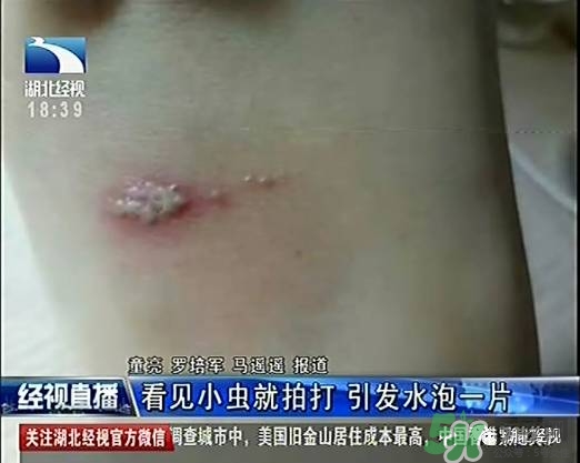 隱翅蟲有毒嗎？隱翅蟲會毀容嗎？