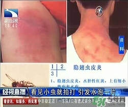 隱翅蟲有毒嗎？隱翅蟲會毀容嗎？