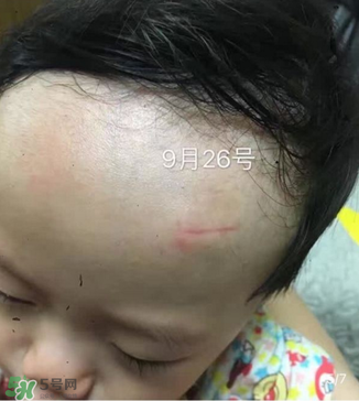 日本msd祛疤膏是抗生素嗎？日本msd祛疤膏是不是抗生素？