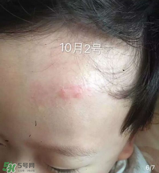 日本msd祛疤膏是抗生素嗎？日本msd祛疤膏是不是抗生素？
