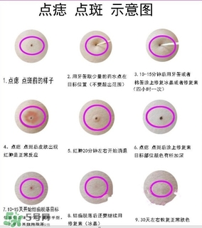藥水點痣和激光點痣哪個好？各有什么優缺點