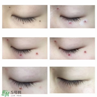 藥水點痣和激光點痣哪個好？各有什么優缺點