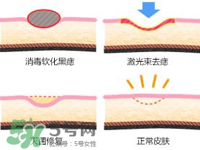 藥水點痣和激光點痣哪個好？各有什么優缺點
