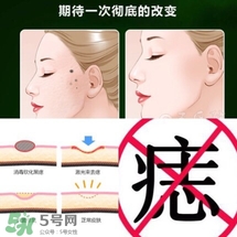 藥水點痣和激光點痣哪個好？各有什么優缺點