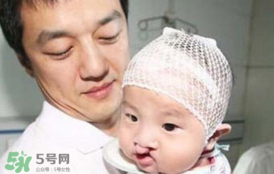 兔唇是什么？兔唇是什么原因造成的？