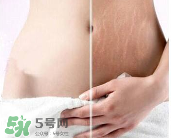 妊娠紋怎么長在大腿上了？妊娠紋會不會長在大腿上？
