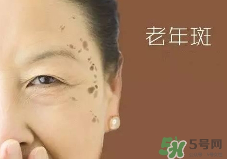 老年斑多大年齡開(kāi)始有？為什么牙膏能去老年斑？