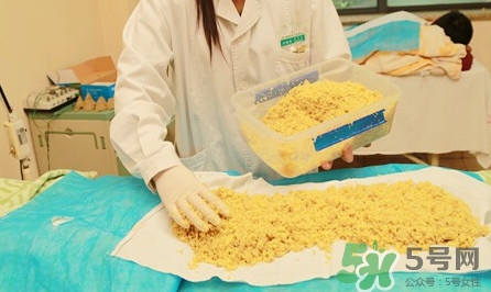 隔姜灸效果怎么樣？隔姜灸好還是直接灸好