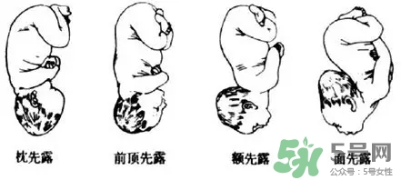 胎位不正能順產嗎？胎位不正怎么辦？