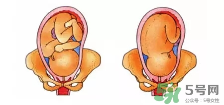 胎位不正能順產嗎？胎位不正怎么辦？