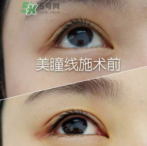 做美瞳線可以吃雞蛋嗎？做美瞳線能吃雞蛋嗎？