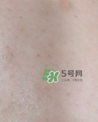 Dermatix舒痕疤痕膏有效嗎？Dermatix舒痕疤痕膏怎么用？