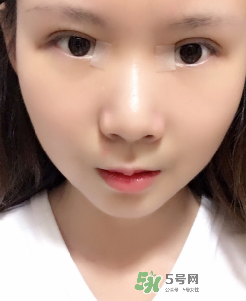 美皮護去疤效果怎么樣？美皮護有用嗎？