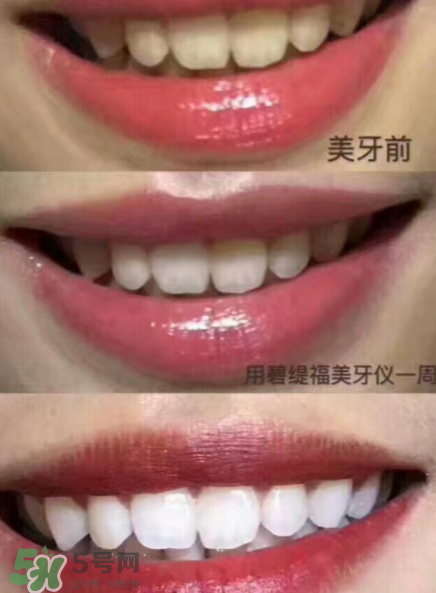 美牙儀能用水洗嗎？美牙儀能用多久？
