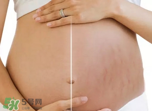 脖子上會長妊娠紋嗎？妊娠紋長在哪些地方？