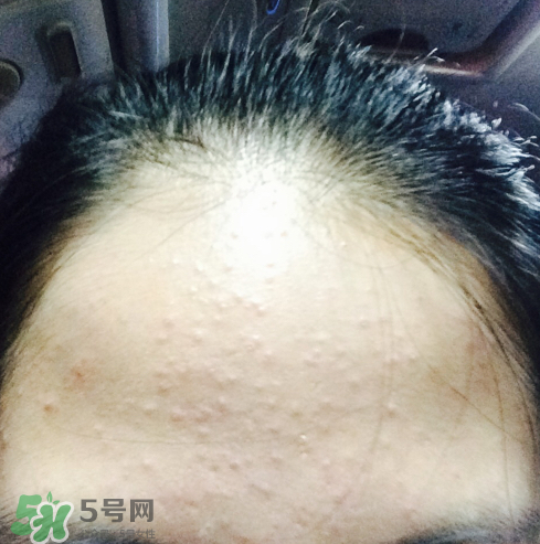 長痘長閉口怎么辦？長痘長閉口是什么原因？