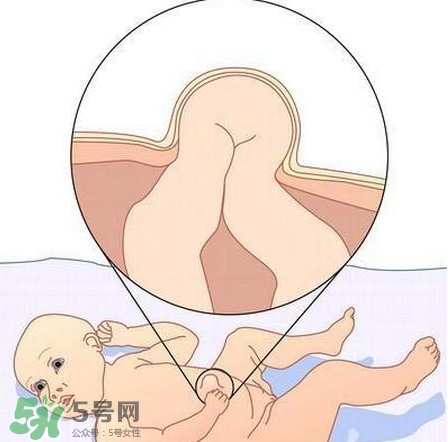 臍疝是什么？臍疝對寶寶有什么影響？