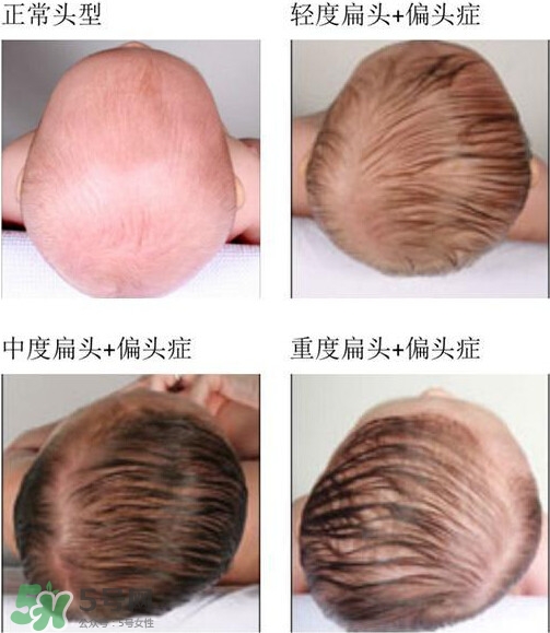 寶寶頭型是睡出來的嗎？寶寶頭型矯正最佳時間