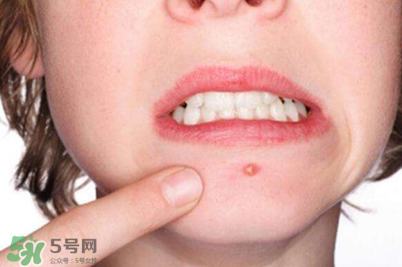 暗瘡可以擠壓嗎？油性和骯臟肌膚會容易有暗瘡嗎？