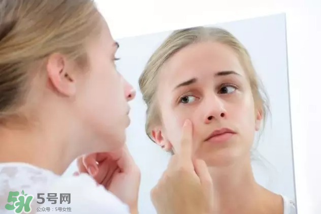 暗瘡可以擠壓嗎？油性和骯臟肌膚會容易有暗瘡嗎？
