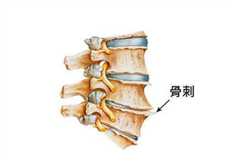 骨刺是怎么形成的？骨刺怎么治療？