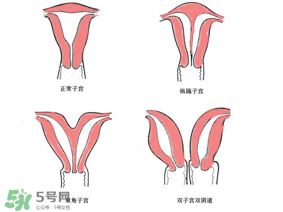 雙子宮是什么意思？雙子宮可以順產嗎？