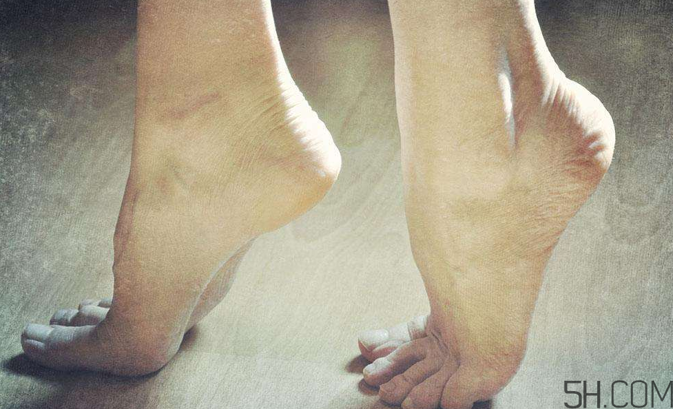 腳氣是什么原因引起的？腳氣是濕氣重引起的嗎?