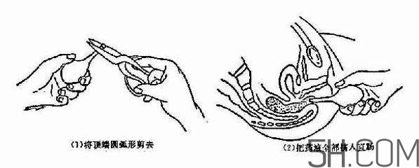 開塞露怎么用？開塞露用后多久會排便？