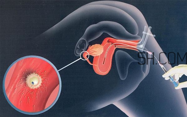 人工授精取卵子怎么取？人工授精男人怎樣取精？