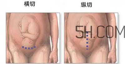 什么情況下需要剖腹產 剖腹產最全科普