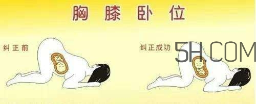 什么情況下需要剖腹產 剖腹產最全科普