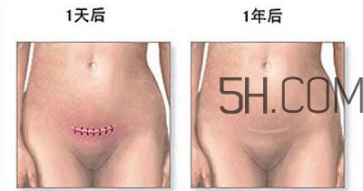 什么情況下需要剖腹產 剖腹產最全科普