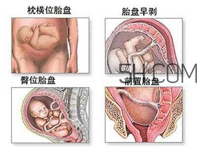 什么情況下需要剖腹產 剖腹產最全科普