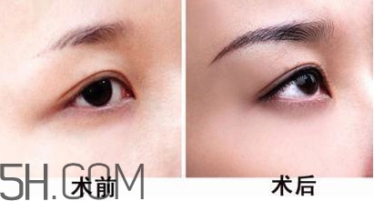 切眉手術(shù)后老得快嗎？切眉能保持多久？