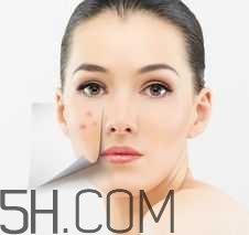 濕熱型痤瘡是什么？怎么調理濕熱型痤瘡？
