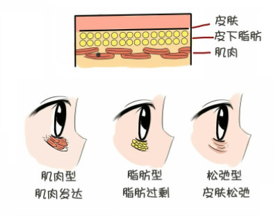 臥蠶和眼袋的區別圖片 7招小技巧掩蓋
