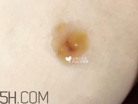 美寶濕潤燒傷膏怎么樣？美寶濕潤燒傷膏有用嗎？