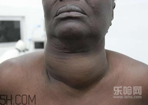 甲狀腺腫大和甲亢的區別有哪些？甲狀腺腫大適合吃什么食物？