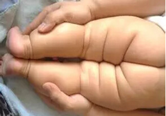 寶寶腿紋不對稱是怎么回事？嬰幼兒的生長發育標準是怎樣的？