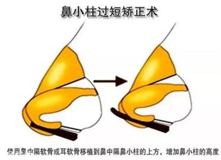 鼻小柱延長用什么材料？優先選擇鼻中隔軟骨