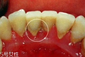 牙結石能自動脫落嗎？除了洗牙別無他法