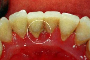 牙結(jié)石能自動(dòng)脫落嗎？除了洗牙別無(wú)他法
